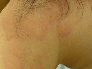 化粧品かぶれアレルギー