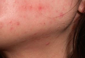 ニキビでシェービング